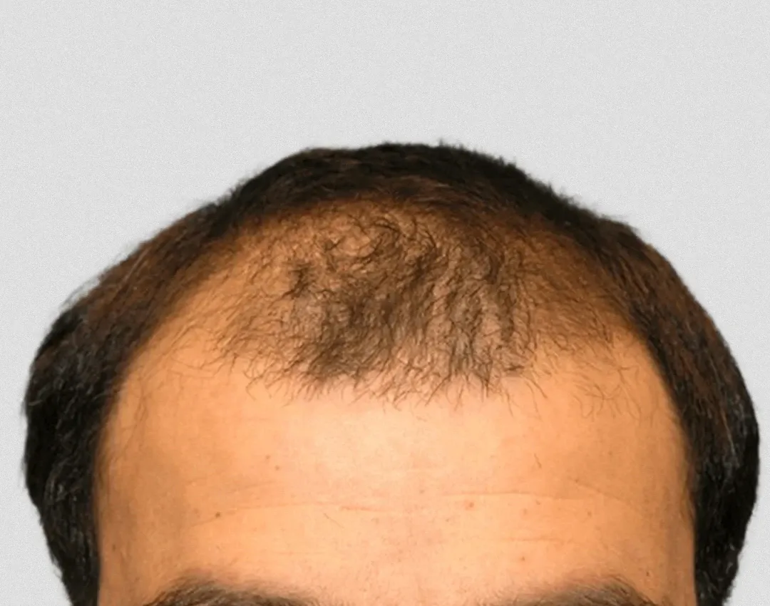 Antes